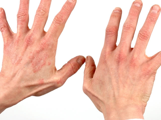 allergicheskij dermatit foto